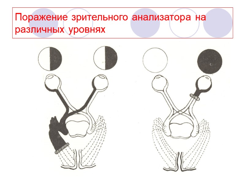 Поражение зрительного анализатора на различных уровнях